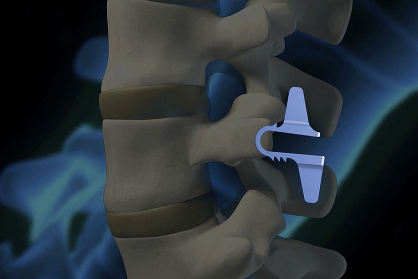 Exploring the Latest Innovations in Spinal Cord Stimulator Trials and Minimally Invasive Procedures