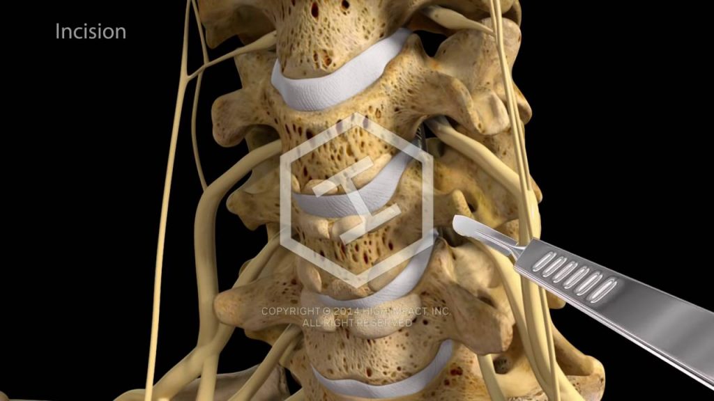 Anterior Cervical Corpectomy and Fusion Surgery