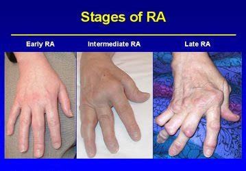 Initial Signs of Rheumatoid Arthritis