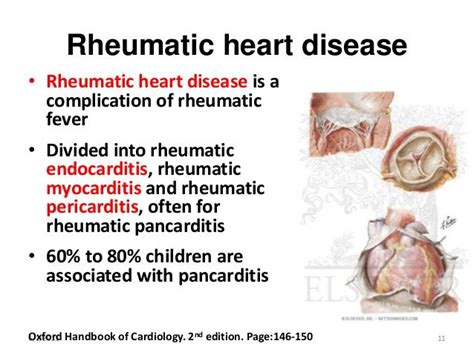 Rheumatic Fever vs Rheumatoid Arthritis