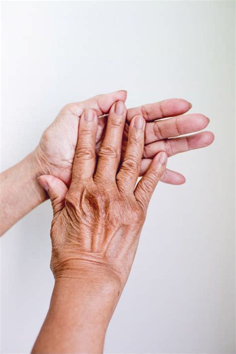 Rheumatoid Arthritis in Hands