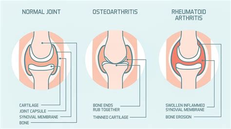 Rheumatoid Arthritis vs. Osteoarthritis: Understanding the Differences
