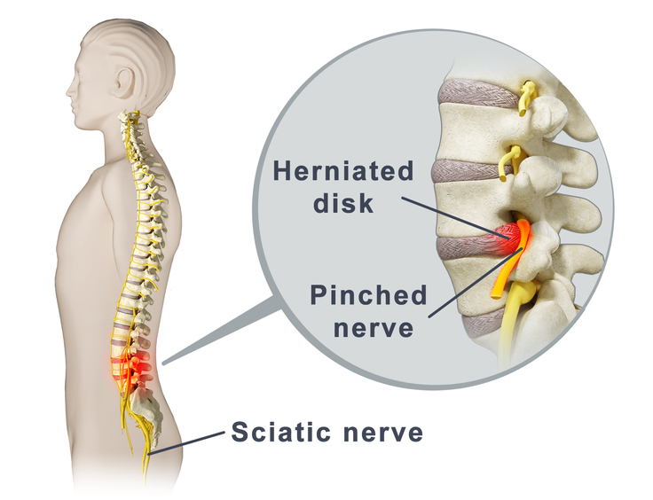 Understanding and Treating a Pinched Nerve: Causes, Symptoms, and Treatments