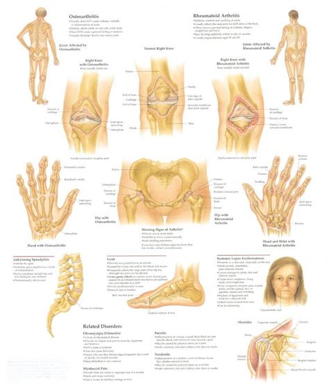 Understanding Arthritis: Symptoms and Causes
