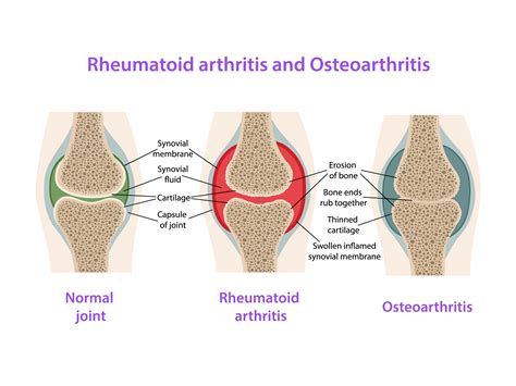 Understanding Arthritis: Symptoms, Causes, and Types