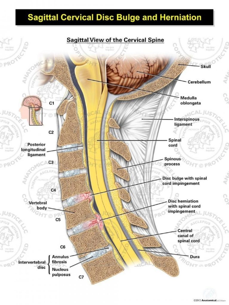 Understanding Cervical Disc Herniation and Its Surgical Treatment