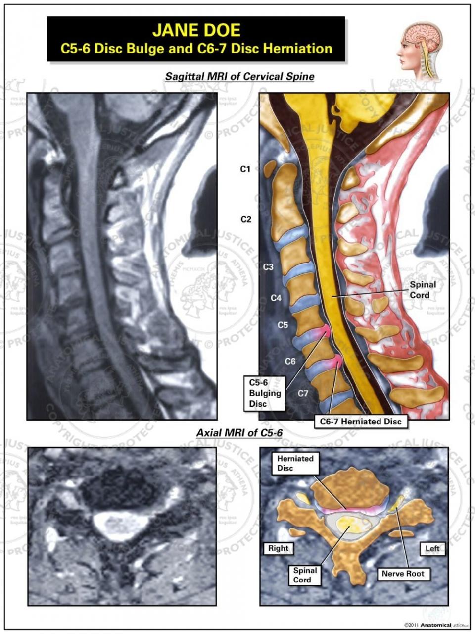 Lateral MRI of Cervical Disc Herniation at C5-C6