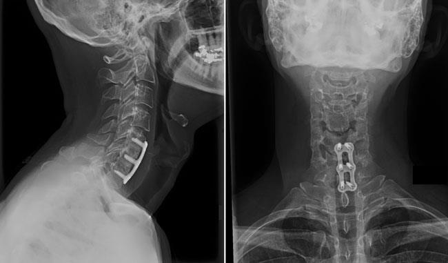 Understanding Cervical Radiculopathy: Surgery and Non-Operative Treatments
