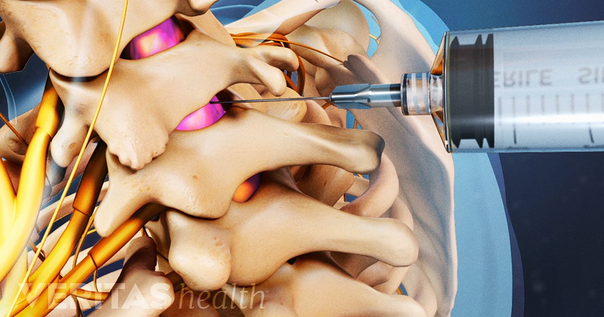 Understanding Cervical Radiculopathy: Treatments and Epidural Steroid Injections
