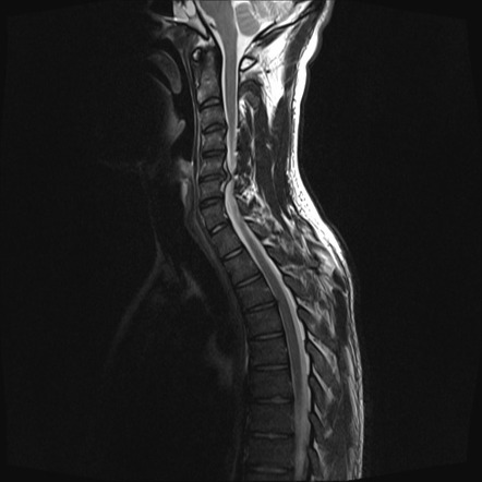Understanding Cervical Spinal Stenosis