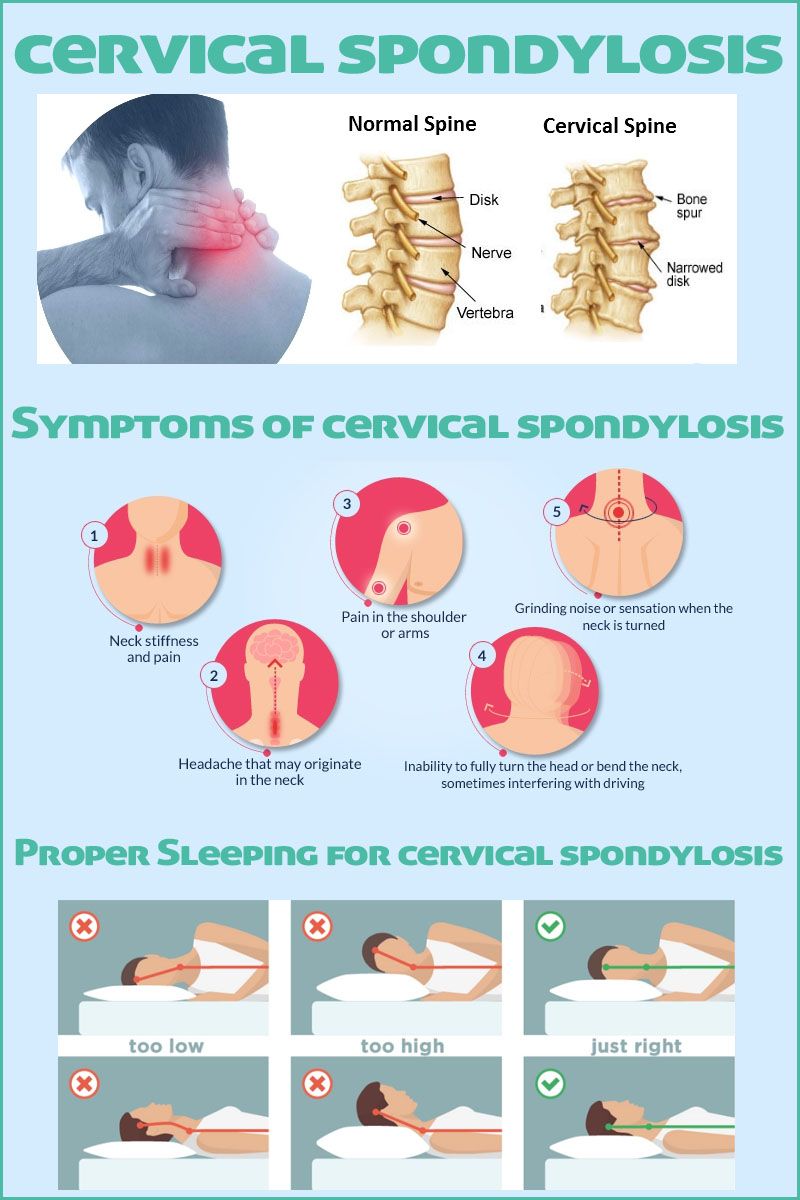 Understanding Cervical Spondylosis Symptoms Causes And Treatment