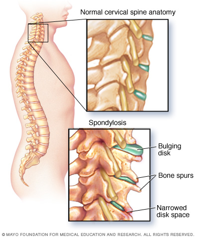 Understanding Cervical Spondylosis: Symptoms, Diagnosis, and Management