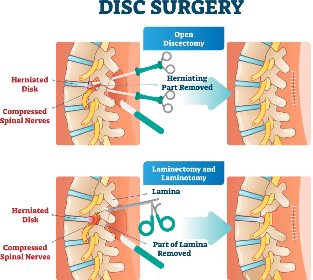 Understanding Different Types of Spine Decompression Surgery