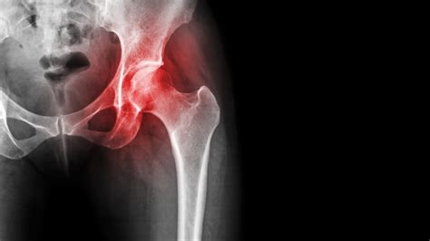 Understanding Early-Onset Inflammatory Arthritis