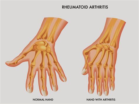 Understanding Early Signs and Symptoms of Arthritis
