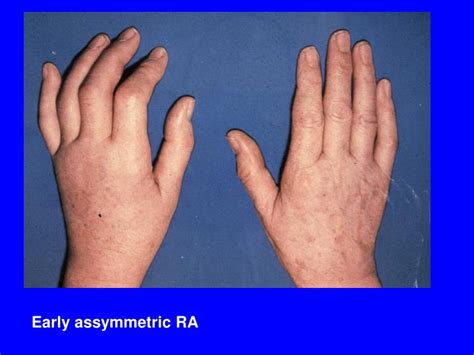 Understanding Early Stage Symptoms of Rheumatoid Arthritis