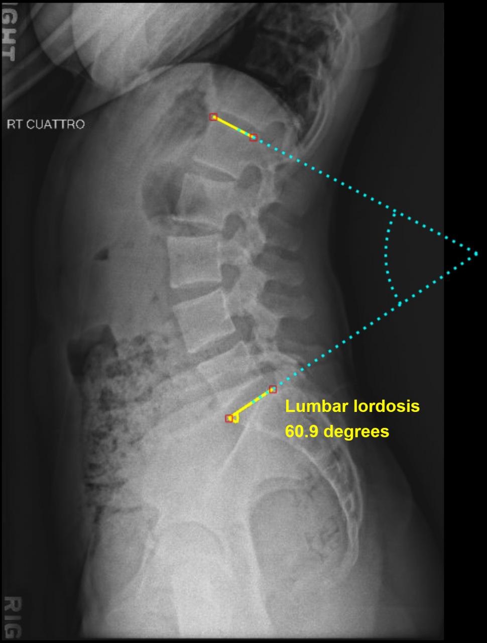 Understanding Flatback Syndrome and Lordosis