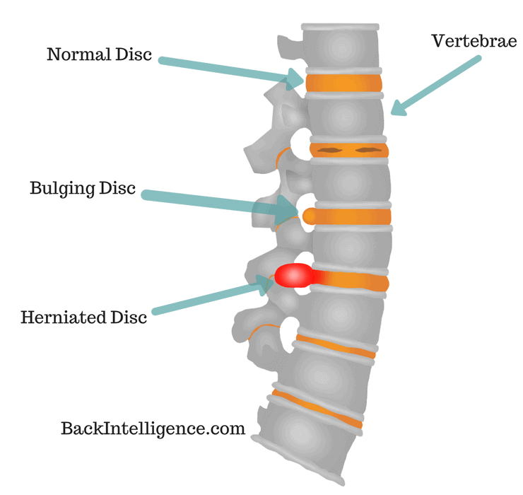 Understanding Herniated Discs: Symptoms, Risks, and Treatments