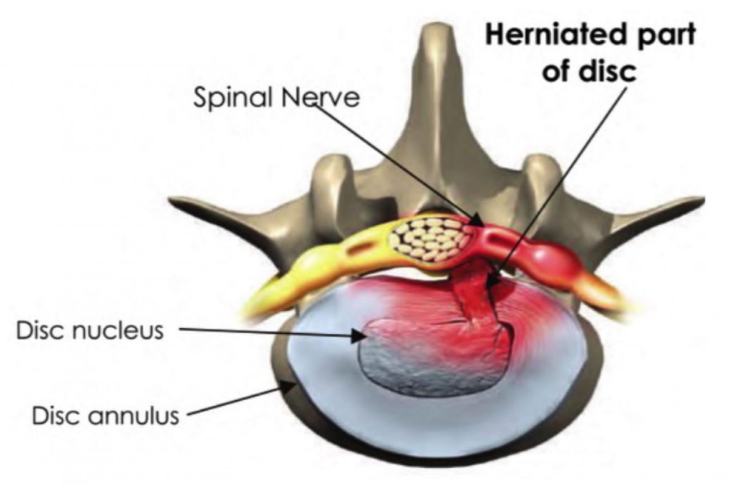 Understanding Lumbar Disc Herniation: Causes, Symptoms, and Treatments