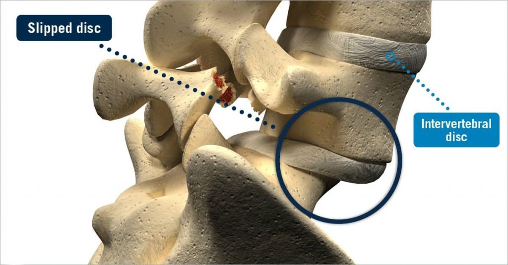 Understanding Lumbar Herniated Discs: Symptoms, Causes, and Treatment Options