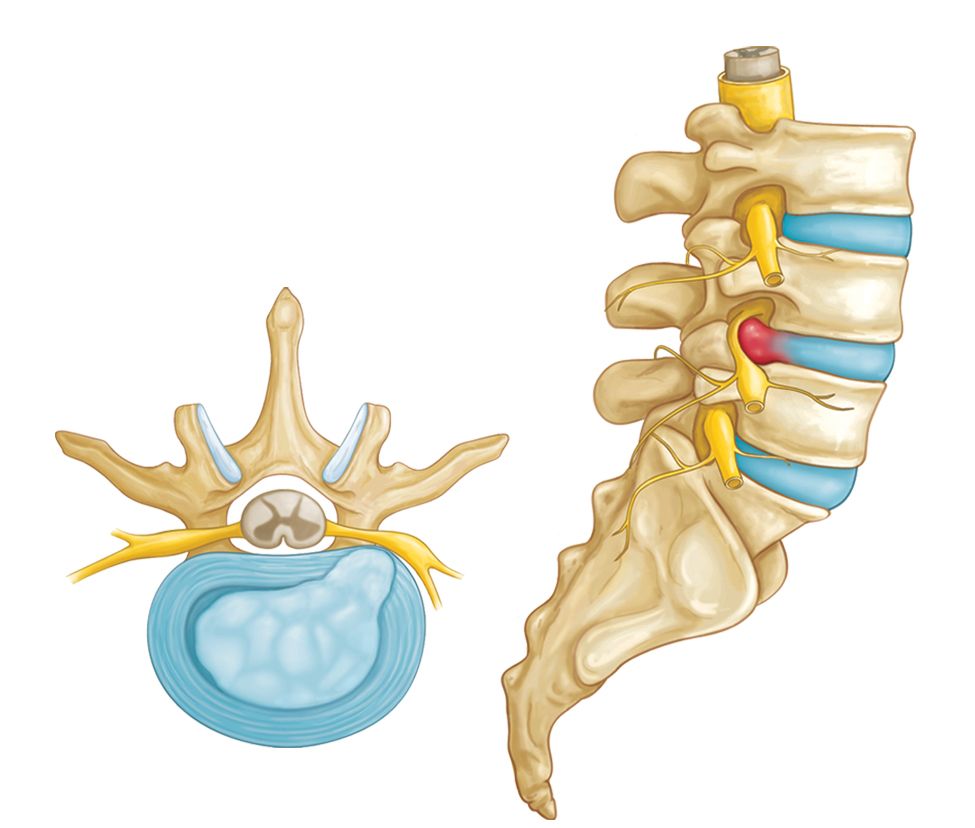 Understanding Lumbar Herniated Discs: Symptoms, Treatments, and Recovery