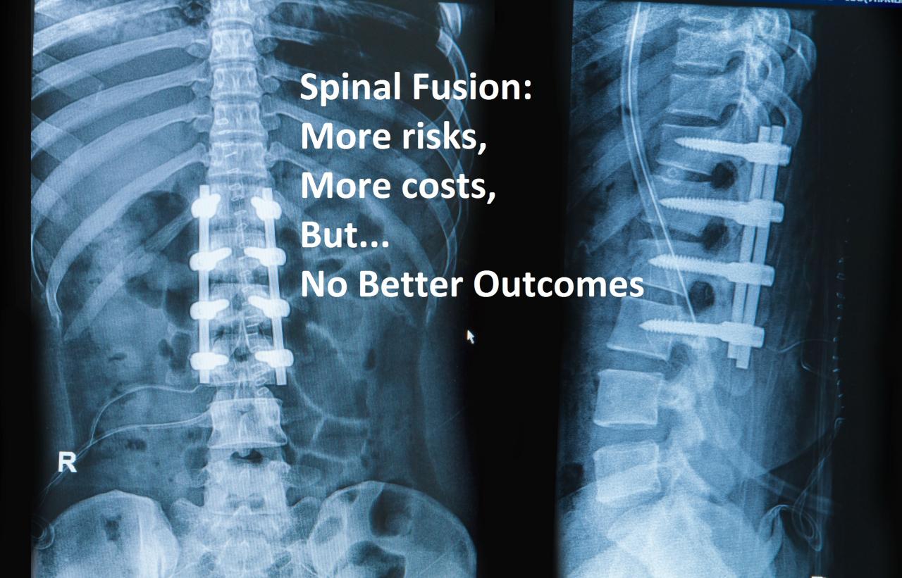 Understanding Lumbar Spinal Fusion: What Is It and When Is It Needed?