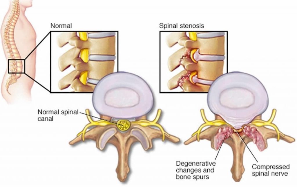 Understanding Lumbar Spinal Stenosis: Symptoms, Causes, and Treatments