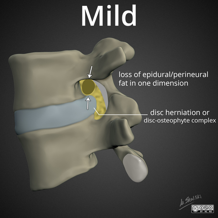 Understanding Mild to Severe Stenosis: Risks and Management