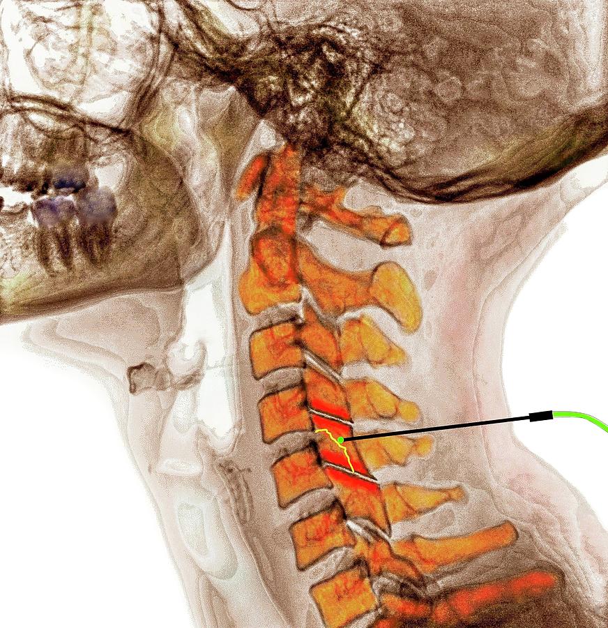Understanding Radiofrequency Ablation: A Minimally Invasive Solution for Back Pain