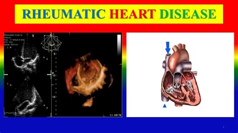 Understanding Rheumatic Diseases: Types, Symptoms, and Causes