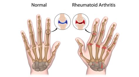 Rheumatoid Arthritis Overview