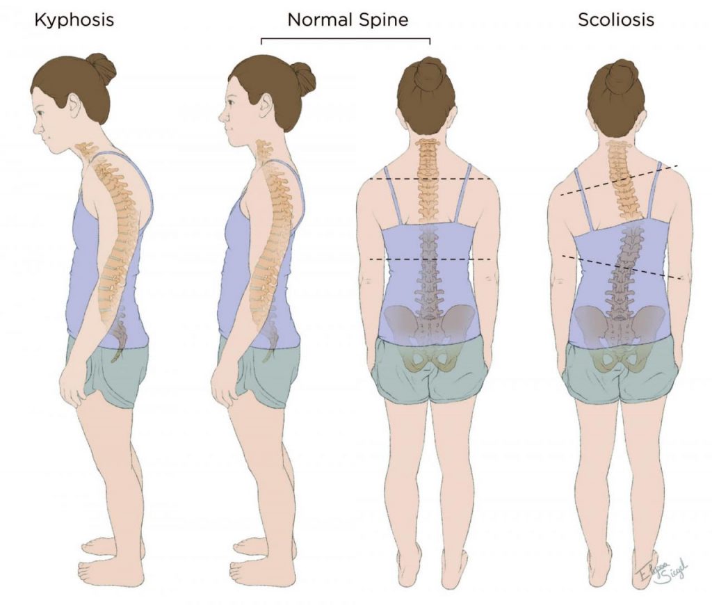 Understanding Scoliosis, Kyphosis, and Spinal Curvatures: Key Insights