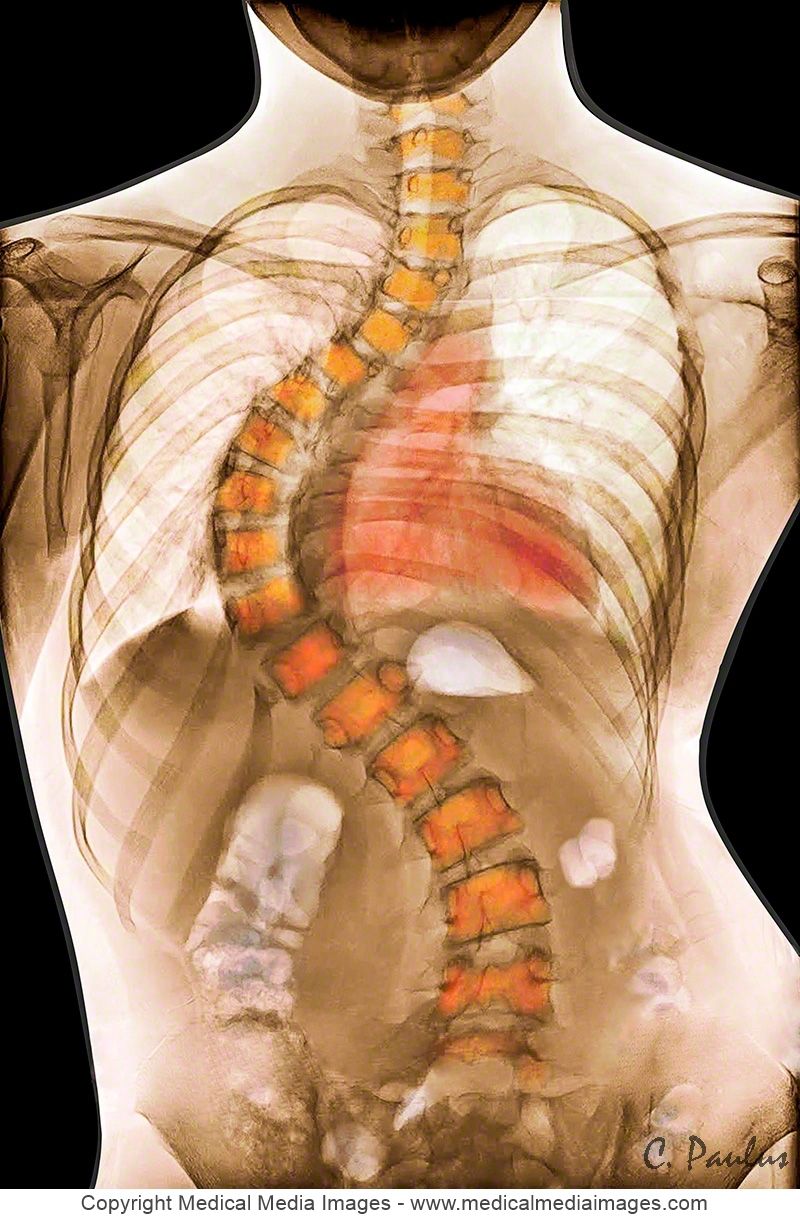 Understanding Scoliosis: Symptoms, Diagnosis, and Treatment Options