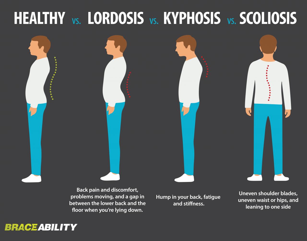 Understanding Spinal Curvatures: Kyphosis, Lordosis, and Scoliosis
