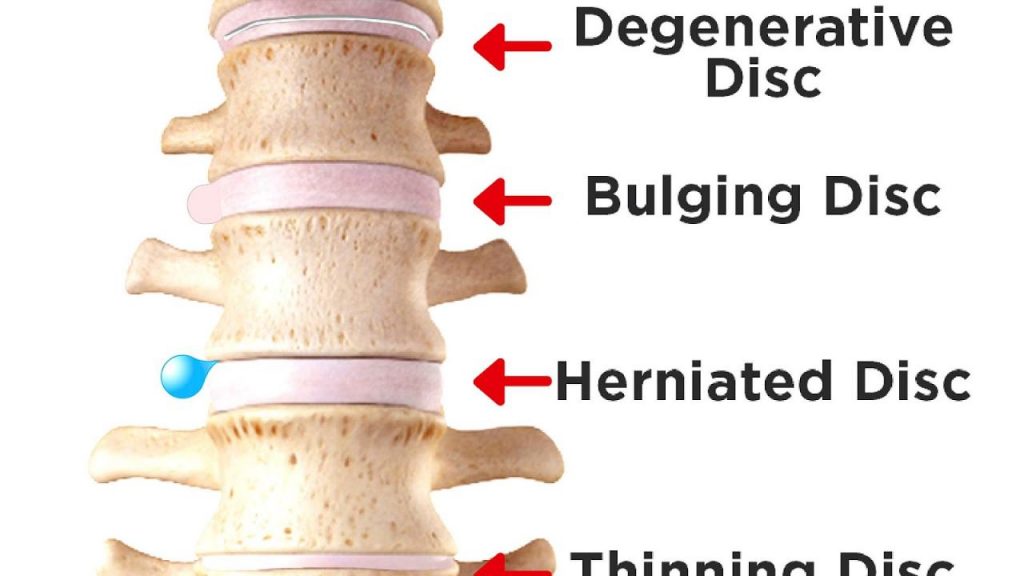 Understanding Spine Decompression Surgery: Types, Symptoms, and Recovery