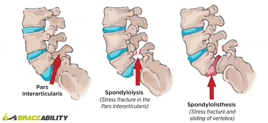 Understanding Spondylosis: Symptoms, Causes, and Treatments