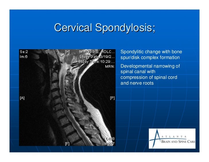 Understanding Symptoms and Diagnosis of Cervical Spondylosis