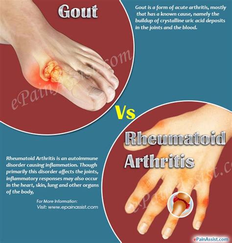 Understanding the Differences: Rheumatoid Arthritis vs. Gout - Becker Spine