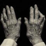 Understanding the Early Signs of Rheumatoid Arthritis