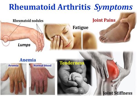 Understanding the Early Symptoms of Rheumatoid Arthritis