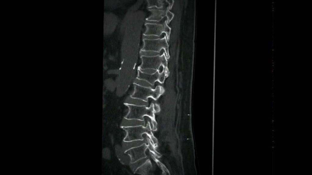 Understanding Treatment Options for Burst and Compression Spine Fractures