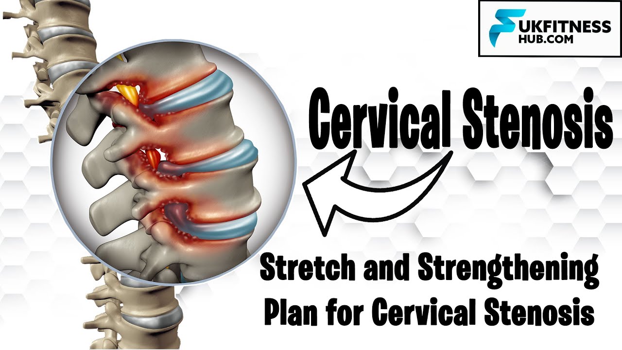 Understanding Treatment Options for Cervical Spinal Stenosis: Surgery and Non-Surgical Methods