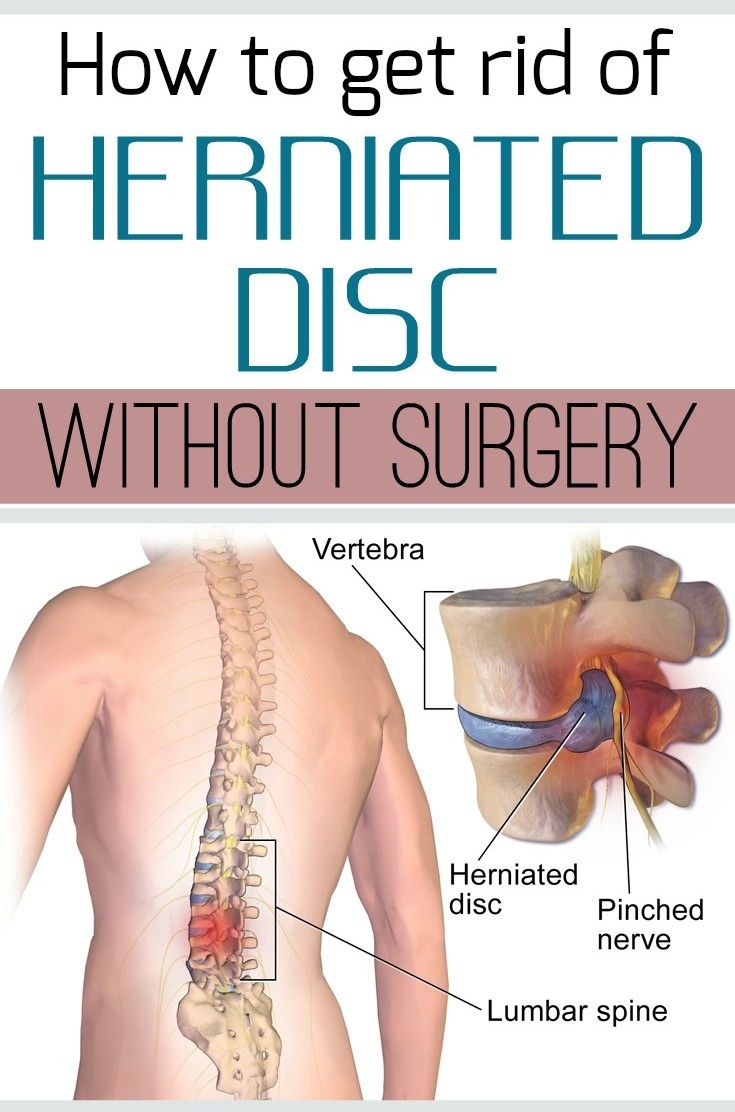 Understanding Treatment Options for Lumbar Disc Herniation