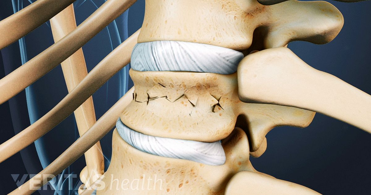 Understanding Treatment Options for Lumbar Spine Fractures