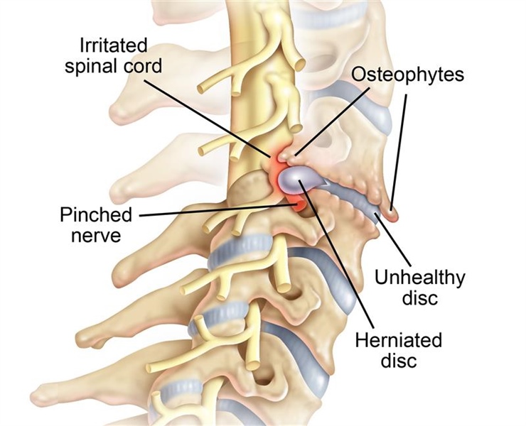Cervical Radiculopathy Causes and Treatment Options