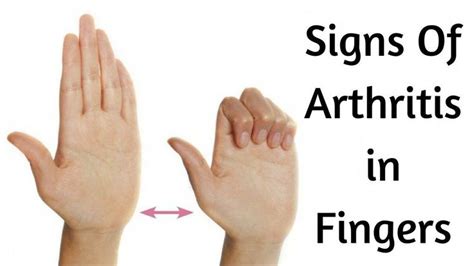 Early Signs of Rheumatoid Arthritis