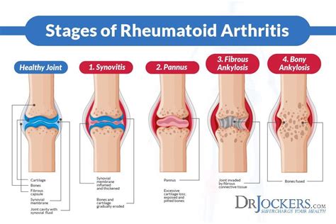 Rheumatoid Arthritis Signs & Symptoms