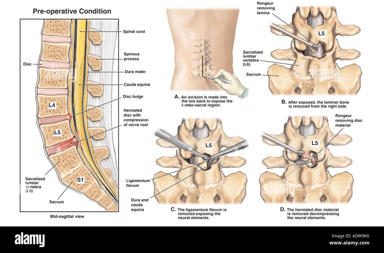 What Are the Outcomes and Procedures for Different Types of Lumbar Spine Surgery?