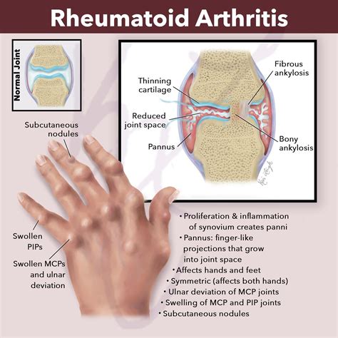 What Are the Symptoms and Causes of Rheumatoid Arthritis?