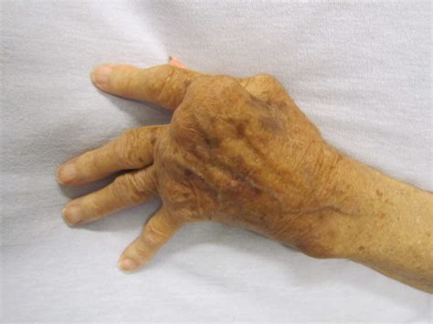 Rheumatoid Arthritis Image